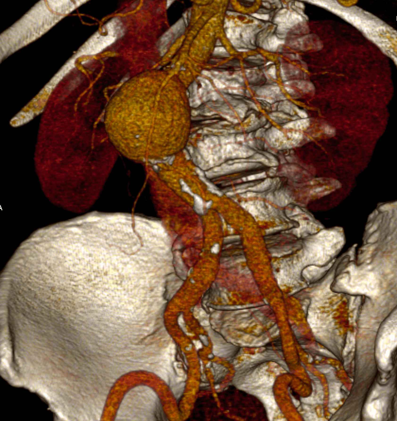 IRM d'une Aorte Abdominale