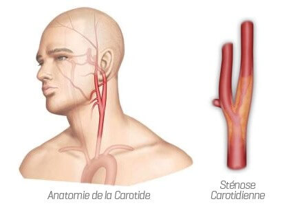 Anatomie carotide