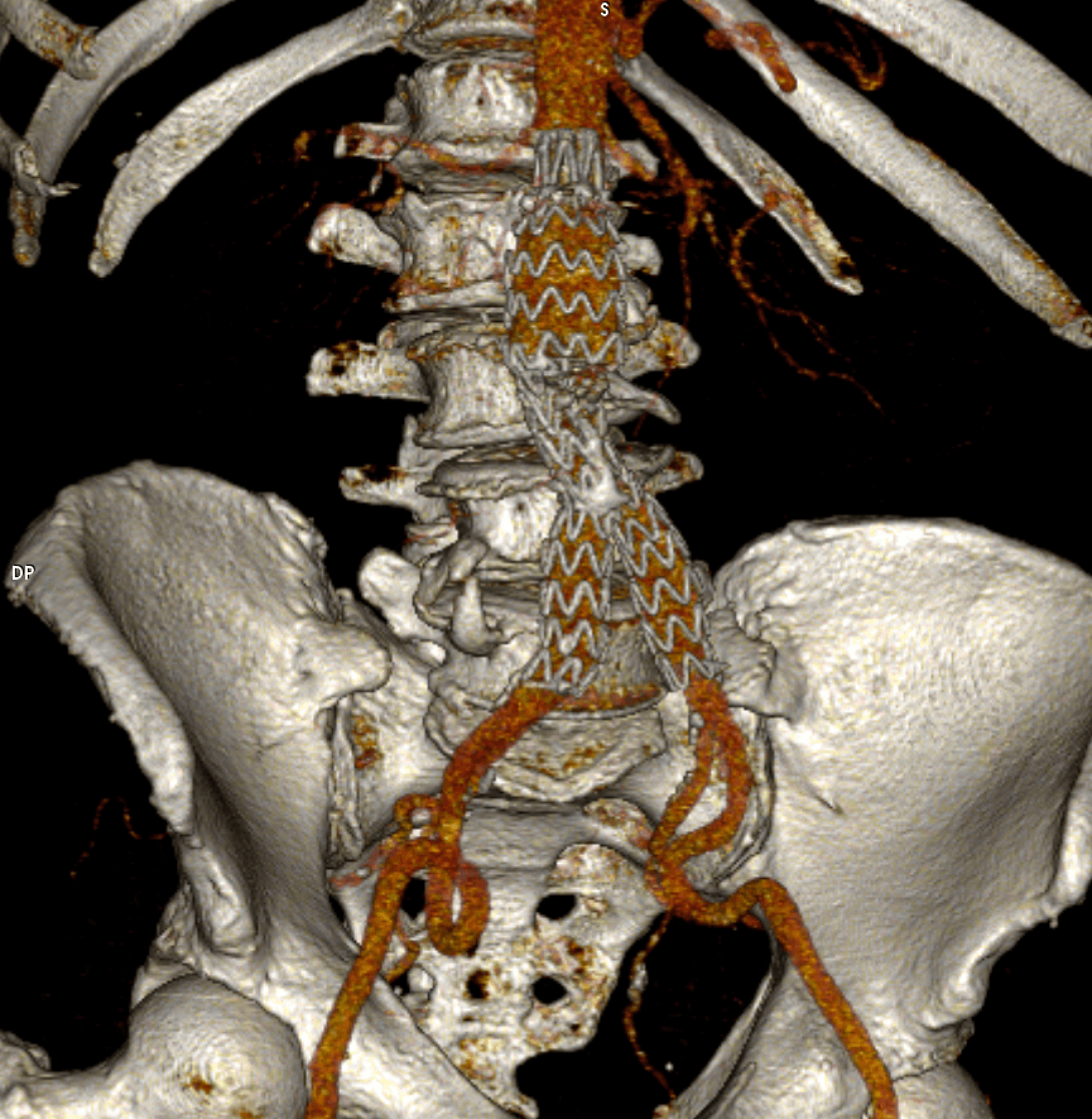 IScanner d'une endoprothèse aortique